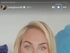 Josie Gibson rivela che le è stato rimosso il 45% del braccio durante un intervento di liposuzione durante la battaglia contro il lipedema