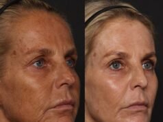 Ulrika Jonsson, 58 anni, rivela i segreti della sua incredibile trasformazione dopo aver subito sei mesi di ritocchi alla pelle per invertire anni di danni del sole