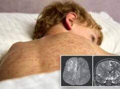 Ragazzo, 7 anni, muore per un disturbo cerebrale causato dalla malattia più contagiosa del mondo, anni dopo averla avuta da bambino