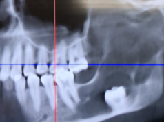 Una donna pensa di aver bisogno della rimozione del dente del giudizio: i chirurghi trovano qualcos’altro