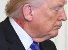 Una violenta eruzione cutanea rossa avvistata sul collo di Trump