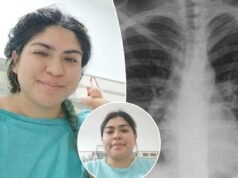 Una donna scopre che l’anello mancante del naso è arrivato ai polmoni, provocandole una tosse durata un mese