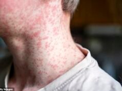 Due bambini muoiono di morbillo con oltre 700 infetti quest’anno mentre i tassi di vaccinazione crollano e i casi aumentano
