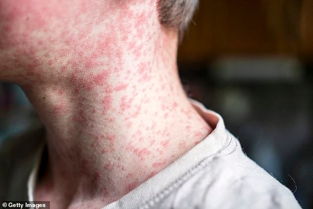 106997367-15891807-Measles_causes_a_distinctive_rash_as_pictured_in_the_above_stock-a-37_1781177300671.jpg