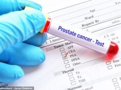 Un nuovo test per il cancro alla prostata rileva tumori più pericolosi rispetto allo screening standard con PSA