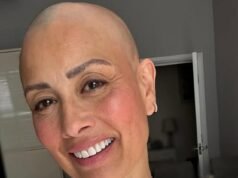 Melanie Sykes mostra con orgoglio la sua calvizie pochi giorni dopo aver ammesso di aver perso “due terzi” dei suoi capelli durante la dolorosa battaglia contro l’alopecia