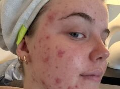 La mia acne debilitante era così grave che mi impediva di uscire di casa. Ho passato anni a provare ogni trattamento finché uno specialista non mi ha rivelato l’unica cosa che mi avrebbe aiutato: ora, per la prima volta in un decennio, ho finalmente una pelle chiara: CHLOE LANDYMORE