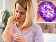 Il morbillo emerge nelle acque reflue della California mentre gli esperti sanitari lanciano l’allarme