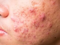 Non è perché ti lavi raramente la faccia, questa è la radice del problema dell’acne che spesso viene trascurato