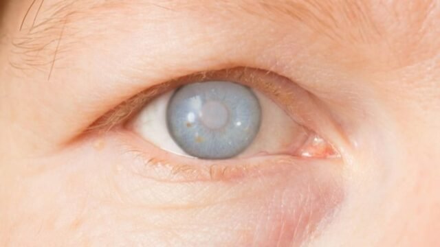 6a5b4977a38a2-ilustrasi-glaucoma_gemini_1265_711.jpg