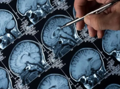 I medici di Mumbai scoprono che una donna affetta da mal di testa ricorrenti soffriva di una rara infezione cerebrale